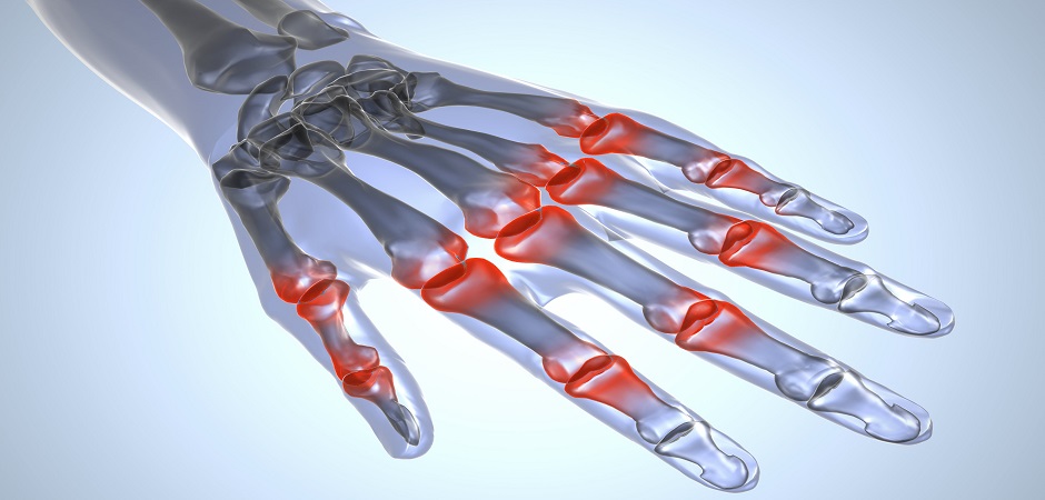 Блуждающий артрит: лечение в Москве